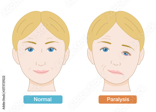 Medical Illustration Showing Facial Asymmetry and Symptoms of Facial Nerve Palsy