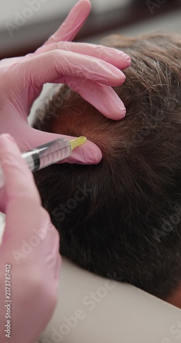 Closeup hair scalp injection for restoration at clinic for medical treatment alopecia.