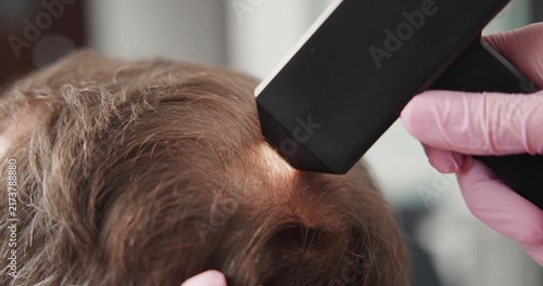 Closeup of handheld scalp scanner examining male hair for follicle analysis, concept men with alopecia.