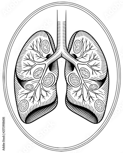 Medical illustration of human lungs with internal nodules and branching bronchial tubes in line art