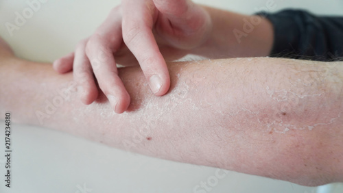 Photography Hand scratching an arm with dry flaky skin