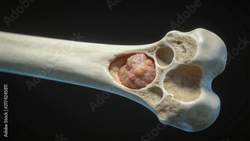 Bone Cancer: Malignant Tumor Lesion of Human Bone Tissue, 3D Medical Anatomical Illustration of Skeletal System Organ