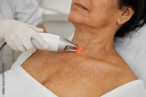 Erbium laser neck resurfacing for wrinkle reduction on mature Indian woman