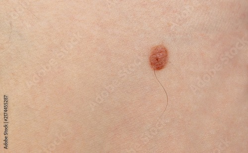 Konstfotografi Skin mole closeup. Macro photo of blemish similar to melanoma