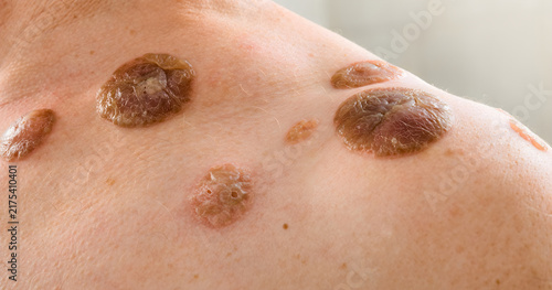 Naklejka Human skin developing lesions on shoulder