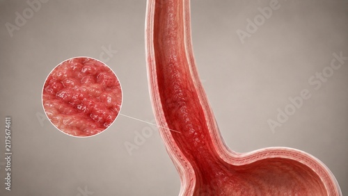 3D Medical Illustration of Barrett's Esophagus with Magnified View of Inflamed Esophageal Tissue