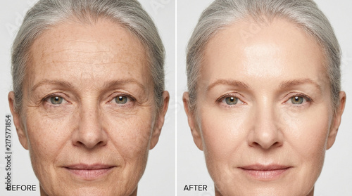 Mature Woman Before and After Skincare Treatment - Anti-Aging Comparison