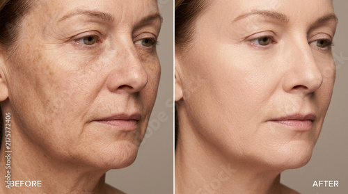 Mature Woman's Face: Before & After Skincare Treatment
