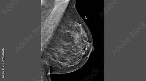 Detailed Mammogram View Revealing Breast Tissue Structures