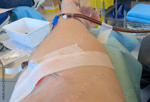 Quadro su tela arm giving blood donation with needle and tube in medical clinic