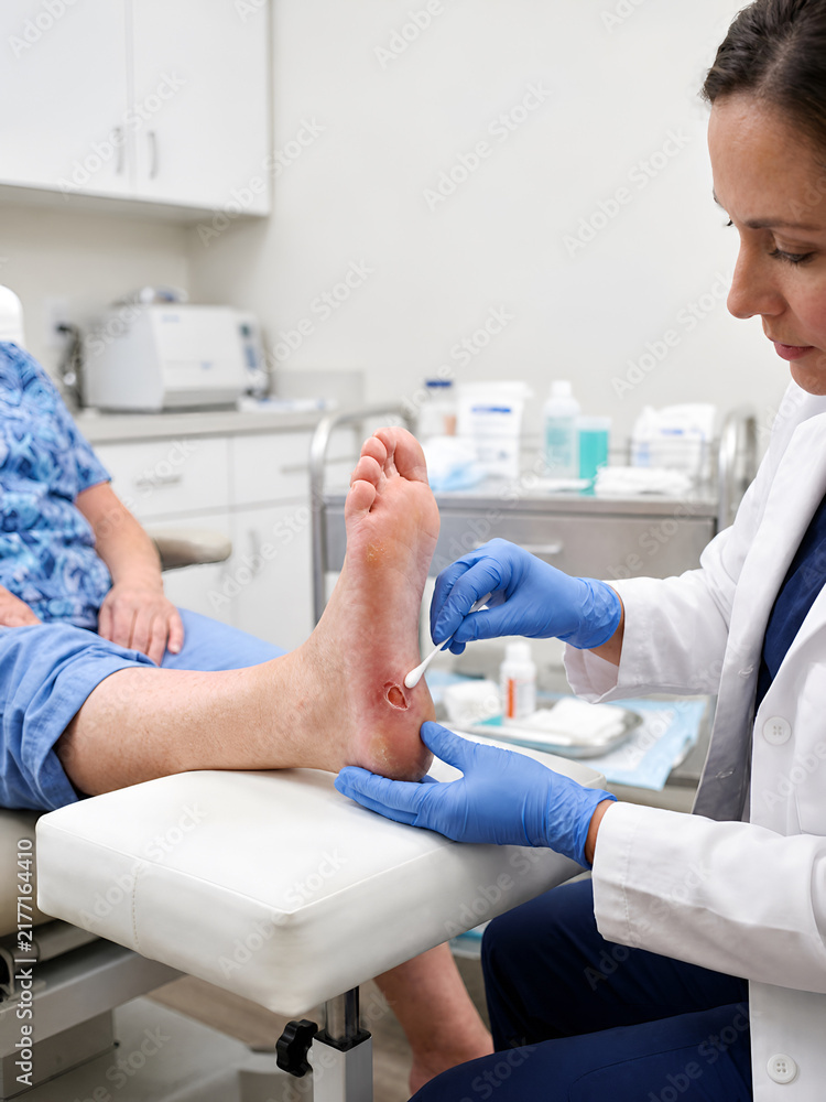 Obraz premium Medical professional examining and treating diabetic foot ulcer in clinical setting