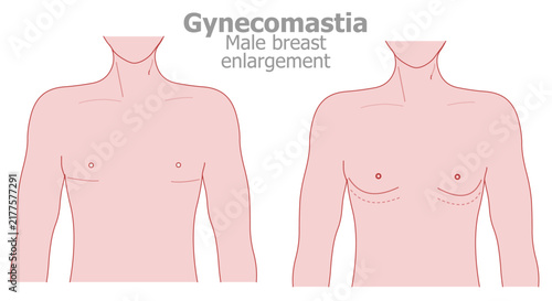 Gynecomastia is a benign, excessive growth of breast tissue in men. Male, man boobs. Illustration vector