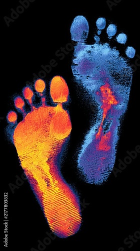 Infrared thermography scan of woman’s feet showing thermal footprints, natural gait pressure pattern, heels and forefoot heat on black background