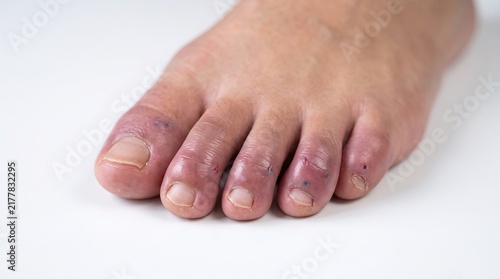 Close Up View of Human Toes with Redness Inflammation and Chilblains