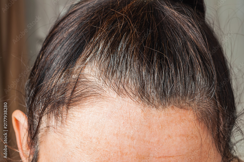 Fototapeta premium Close-up of thinning dark hair and receding hairline on a person's forehead