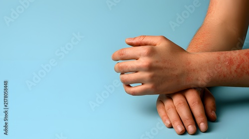 Close-up of severe red skin rash and allergic reaction dermatitis on patient arms isolated on blue background, eczema concept
