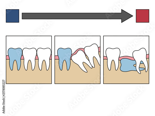 Tooth Shifting and Impaction Dental Diagram Over Time