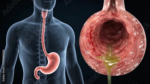 3D Animation of Human Torso Showing GERD and Acid Reflux Disease in Inflamed Stomach