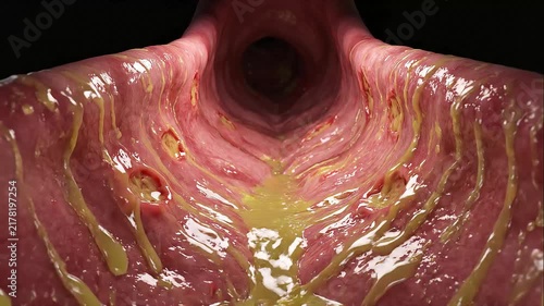 3D Animation of Stomach Acid Splashing Up Esophagus Causing Severe Heartburn