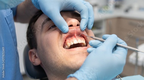 Dentist Examining Male Patient Teeth Using Metal Probe Tool In Clinic With Blue Gloves And Medical