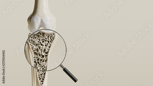 Obraz na plátně Magnifying glass showing osteoporosis bone structure inside knee joint 3d render