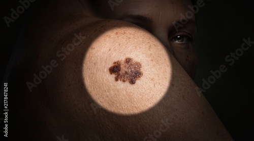Close up of an irregular dark mole melanoma on woman's shoulder with spotlight effect