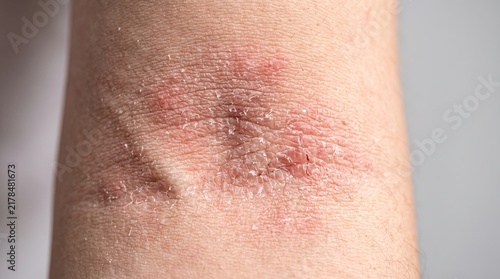 Macro shot of dry cracked scaling skin from severe eczema or atopic dermatitis on inner elbow