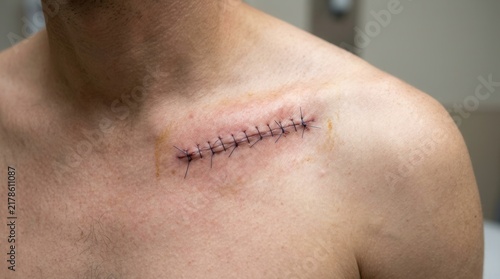 Surgical Incision With Stitches Healing After Medical Procedure On Shoulder