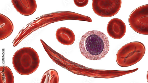 Obraz na plátně Sickle cell anaemia, 3D illustration of sickle-shaped red blood cells among norm