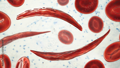 Foto Sickle cell anaemia, 3D illustration of sickle-shaped red blood cells among norm