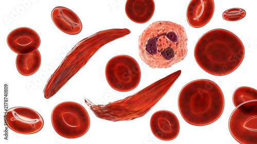 Foto Sickle cell anaemia, 3D illustration of sickle-shaped red blood cells among norm