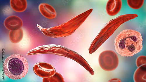Canvas Print Sickle cell anaemia, 3D illustration of sickle-shaped red blood cells among norm