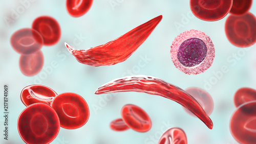 Sickle cell anaemia, 3D illustration of sickle-shaped red blood cells among normal erythrocytes circulating in blood