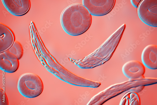 Sickle cell anaemia, 3D illustration of sickle-shaped red blood cells among normal erythrocytes circulating in blood