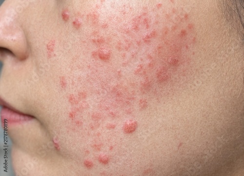 Close up view of a young persons face with severe acne and skin blemishes