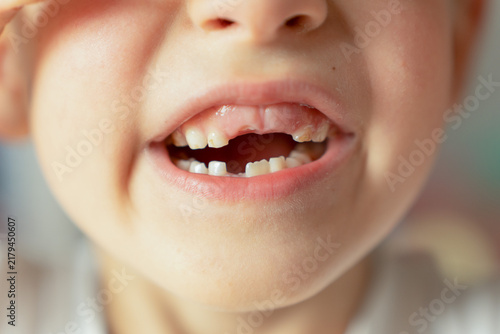 Foto A close-up of a child's smiling mouth showing missing upper and lower milk teeth, representing the natural tooth-shedding phase in childhood