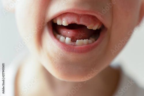 Foto A child with an open mouth showing the absence of upper and lower milk teeth, highlighting dental growth and the natural tooth loss stage