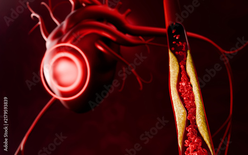 Blood Flow Through Narrowed Artery with Cholesterol Buildup Showing Clogged Blood Vessel and Risk of Heart Disease and Stroke 3D Rendering
