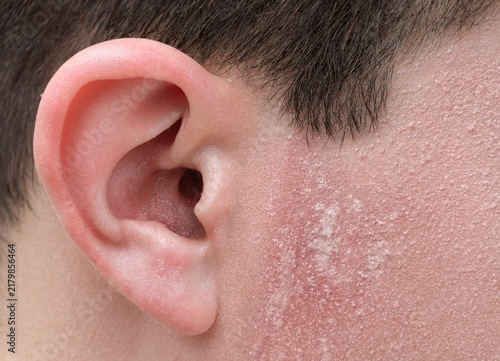 Closeup human ear showing skin irritation and flaking around the facial area
