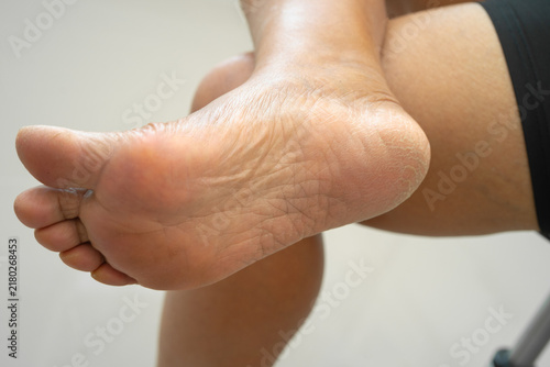 Asian woman care feet with cracked and dry heel skin cream at home.