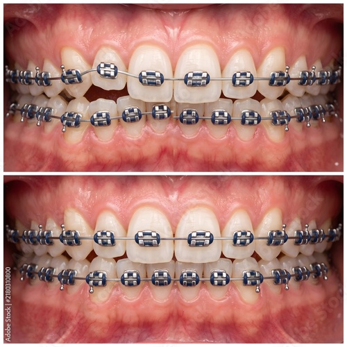 Teeth Alignment Progress During Orthodontic Treatment with Traditional Metal Braces
