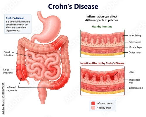 Inflammation and Irritation of the Intestinal Wall in Crohn’s Disease