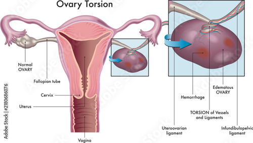 Medical illustration showing ovarian torsion, with annotations.