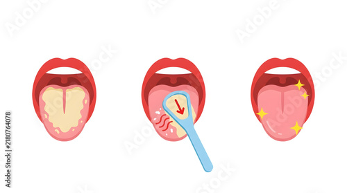 Tongue cleaning process with scraper vector illustration isolated on transparent background