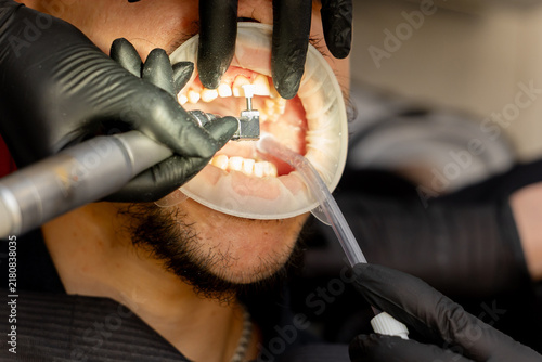 Foto Dentist polishing patient teeth with rotary tool and saliva ejector
