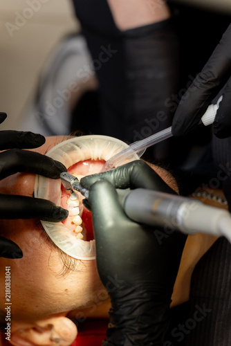 Fotografía Dentist polishing patient teeth with rotary tool and saliva ejector