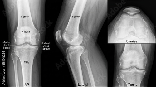 Multiple Radiographic Views Of Human Knee Joint Anatomy