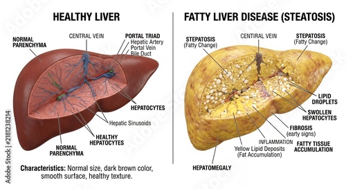 Healthy Liver vs Fatty Liver Disease Comparison