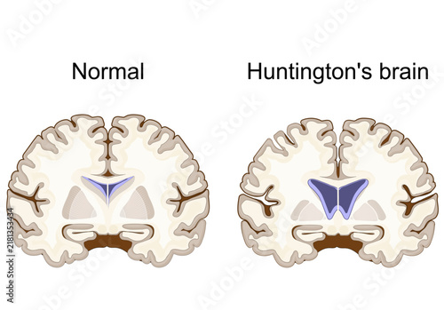 Huntington's brain comparison. Huntington disease HD. Huntingtons chorea. Fatal neurodegenerative inherited disease.