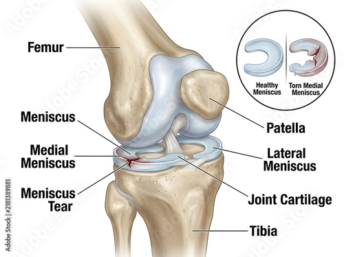 Knee anatomy diagram showing torn medial meniscus injury isolated on white background
